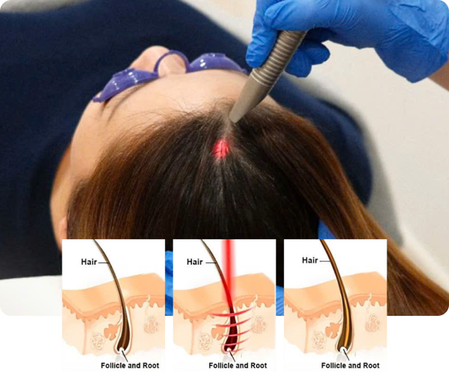 Root Renewal Treatment